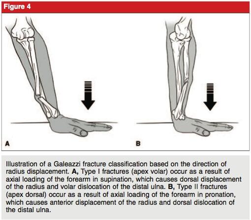 Galeazzi Fracture