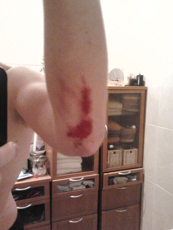 Ivarmes's tweet image. Onderuit gegaan met hockey knie ligt open en elleboog naar de klotwn