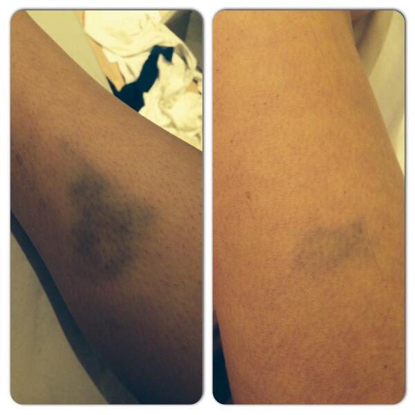 Iz_Holmesey's tweet image. Lovely bruises from netball #owchie #warwounds 😣 phobos.apple.com/WebObjects/MZS…