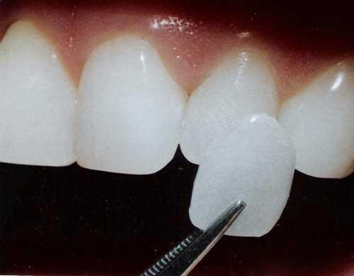 drdubeydental's tweet image. Mask the #discolorations and brighten your teeth through #DentalVeneers @dubeysclinic .Visit goo.gl/p0fHxA
