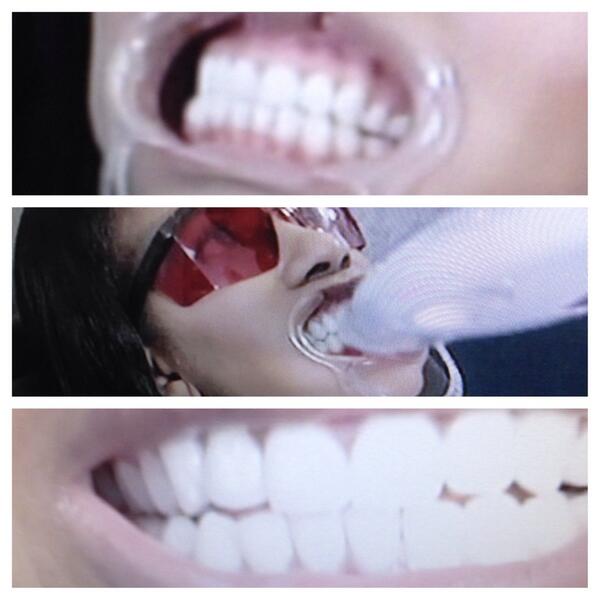 livingdaytontv's tweet image. No filter here. Top to bottom: before , during, and after @VanessaFreeTV gets a #teethwhitening ! #smilelab