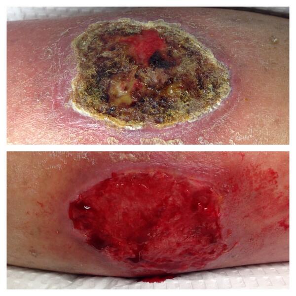 WoundSmart's tweet photo. Of course what you put in a #wound  is important but what you take off is even more so! @CellerateRX @Puracyn http://t.co/Pj6KYrJhxg