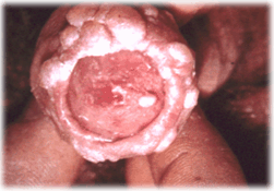 quererconocer's tweet photo. Verrugas genitales en pene. http://t.co/ODiDAeQiGP