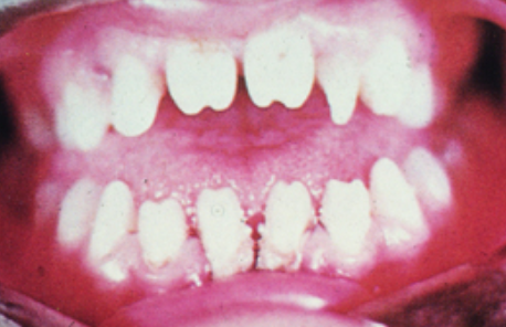 Xavier Veas on Twitter: "“@IlindelatorreMD: Dientes de Hutchinson.  Indicativo de Sífilis congénita. Vía eponymsaretheworst.  http://t.co/PoeykUeqrf”@helenverov" / Twitter