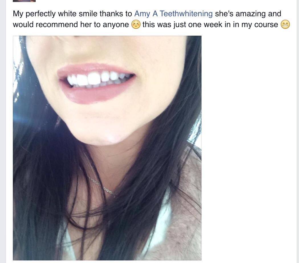 CliponVeneersuk's tweet photo. #teethwhitening http://t.co/3tUfU2Wrk4