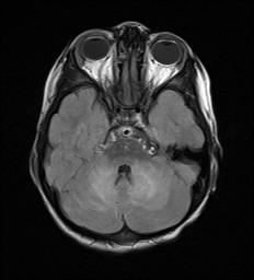 JennyKHoang's tweet photo. 3yo with ataxia. Recent viral infection. Diagnosis? http://t.co/l8woDtHiEO #ACRedu #Dukerad15 http://t.co/ljSJJPqKj3