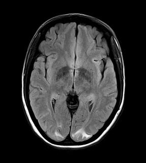 JennyKHoang's tweet photo. Seizure and headache. Diagnosis? http://t.co/NLzhHYrxa8 #ACRedu #DukeRad15 http://t.co/icOrIo2b3U