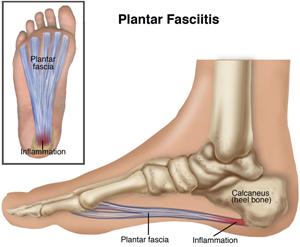 outpatientpt's tweet photo. Learn more about plantar fasciitis and how a physical therapist can help: http://t.co/JKXXHYZrQj. http://t.co/t8Lgc5Nin8