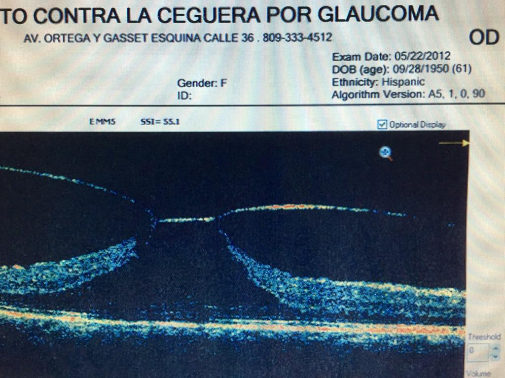 vitreo_retina's tweet photo. #PreQx #síndrome #tracción #vitreo #Macular #resultados #PostQx #2años AVMC 20/25 #mispacientes http://t.co/yU2i2gCbhd