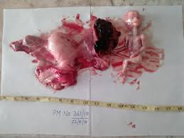 TheProLogic1's tweet image. There is no way to save an #ectopic #pregnancy. It cannot turn into a #normalpregnancy
@Gidi_Traffic @NigeriaNewsdesk