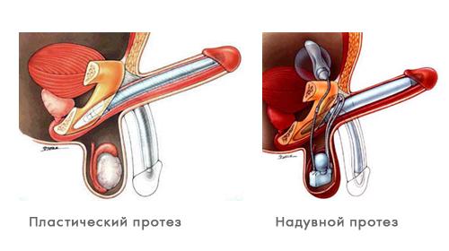 uroprofit din prostatită prostatodinia pdf