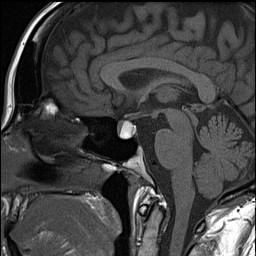JennyKHoang's tweet photo. Diagnosis? Has characteristic intracystic nodule http://t.co/l7jbceNQ4V #ACRedu #Dukerad15 http://t.co/WDspt18Ilh