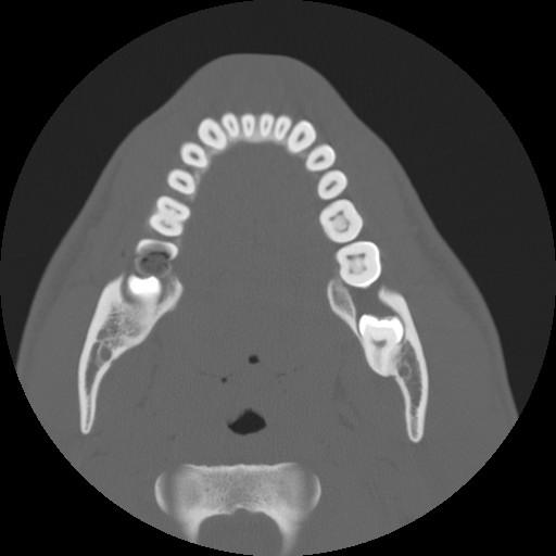 JennyKHoang's tweet photo. Hate jaw lesions? Diagnosis? ANSWER: http://t.co/H4Y7S7yGts #ACRedu #DukeRad15 http://t.co/3OIK0JKmVH
