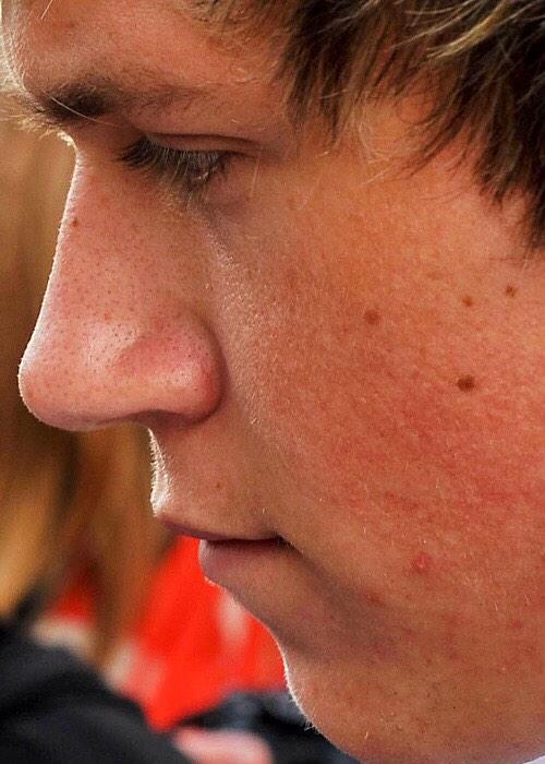 appreciationjh's tweet photo. NIALL'S FRECKLES APPRECIATION TWEET http://t.co/7uTlLu0meR