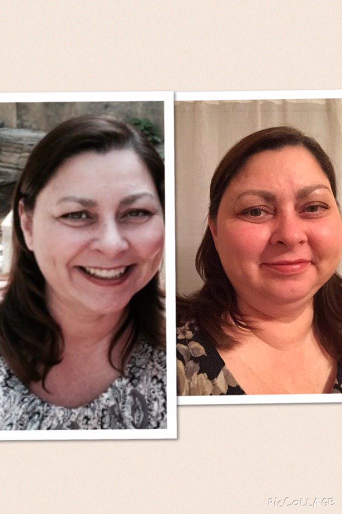 Puffy Face From Prednisone