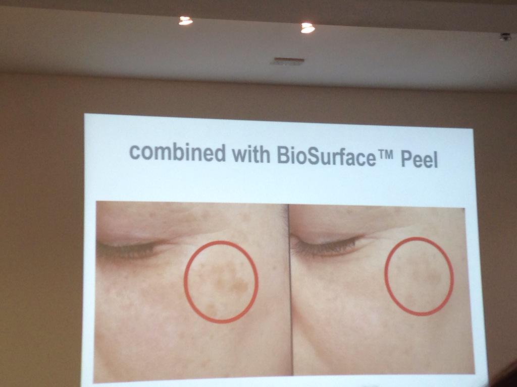DianaGlowgetter's tweet photo. Results after 4 weeks @DermalogicaUK1 #PowerBrightTRx regime #DrDianaHoward #reducepigmentation http://t.co/0E7f3aLvWr