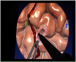 AI_SimCentre's tweet image. Dr. Sabbagh helped design a number of VR brain tumour resection scenarios while a fellow in the Neurosurg Sim Centre.