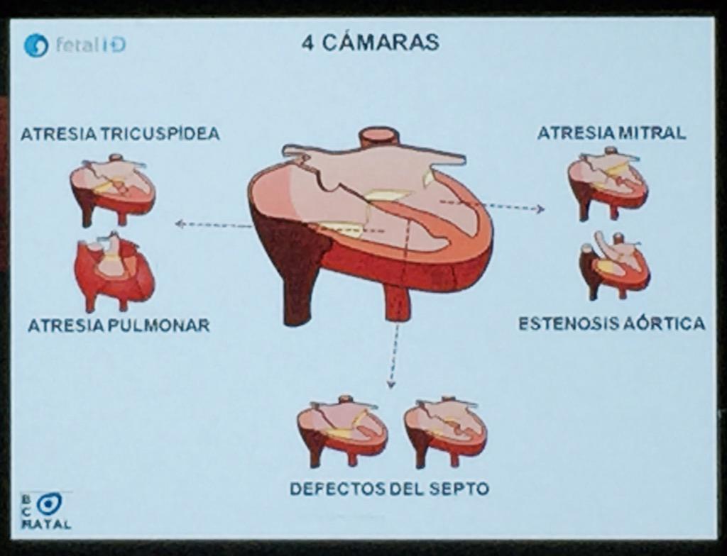 MaternoFetalMX's tweet photo. #cuatrocamaras #Screening #ecocardiografia #fetal #medicinafetal #diagnosticoprenatal #seva2015 @medfetalBCN http://t.co/J8BOlbYrMY
