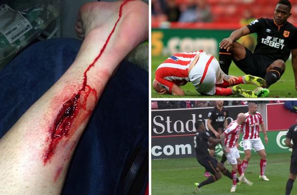 Stephen Ireland's calf after Maynor Figueroa's horror challenge..