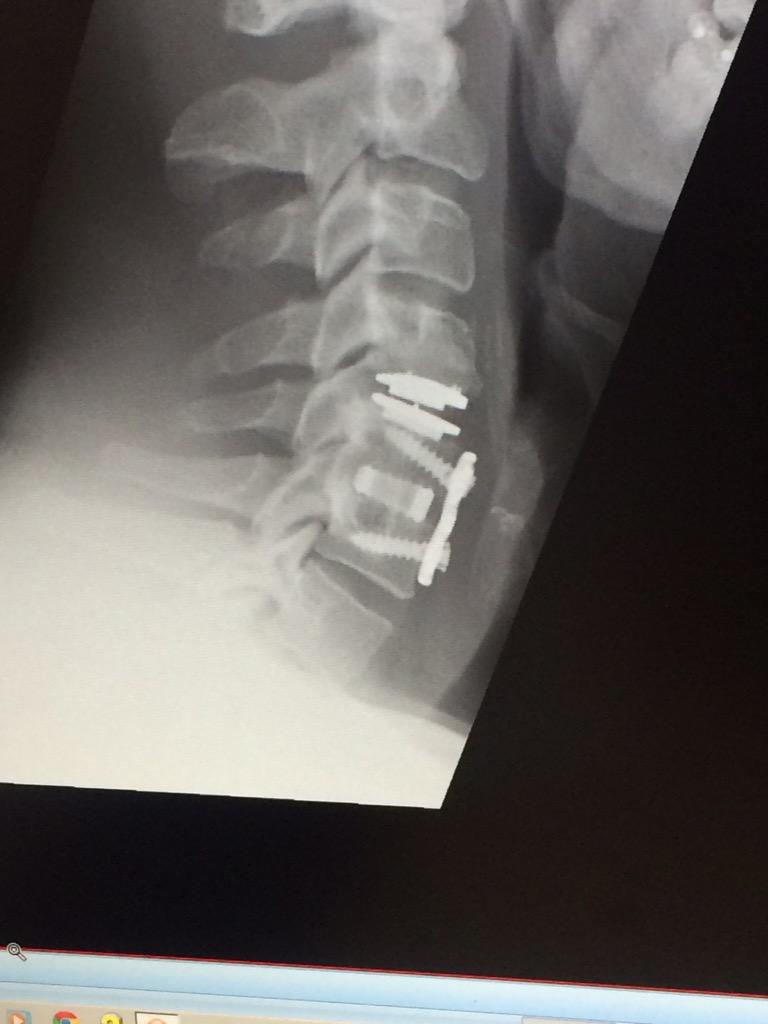 Kirk_Dicko's tweet photo. Neck is looking well🙈 got to love rugby........... http://t.co/P870PhHLUr
