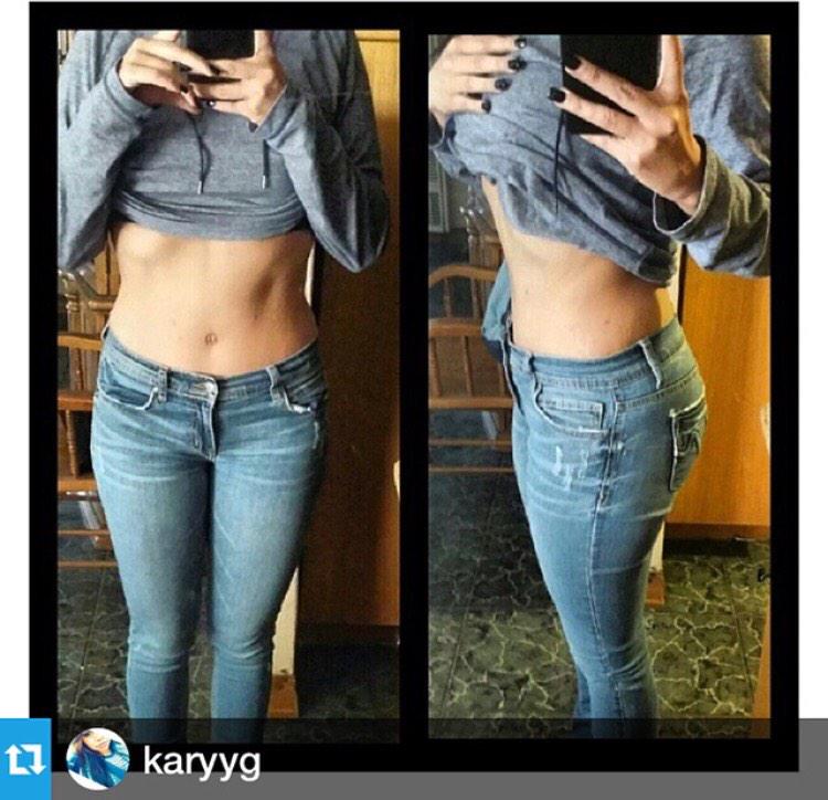 Look at this amazing #tummytuck post-op! #MyLook #DrTaneja