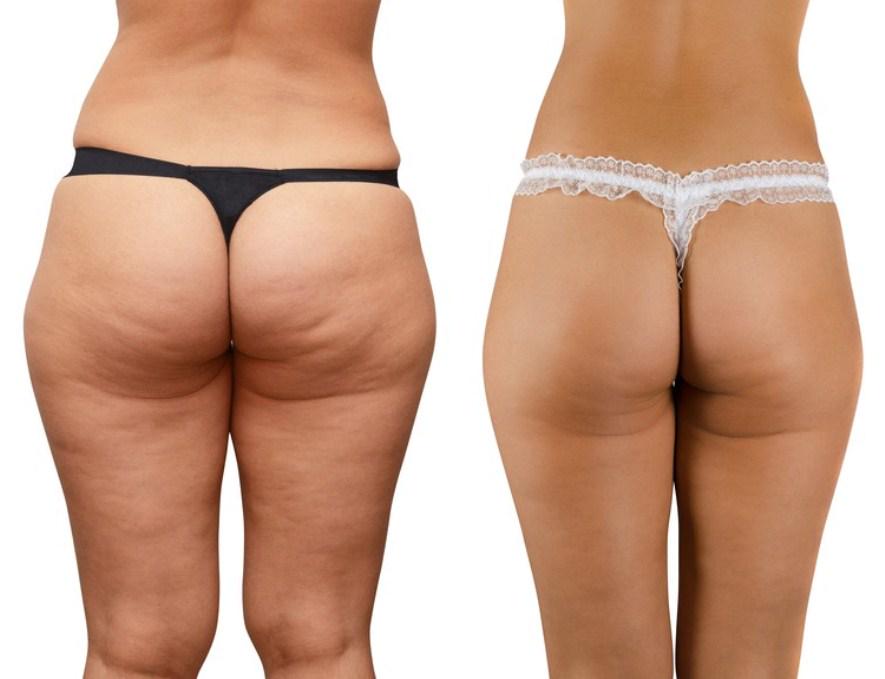 CelluliteHelper's tweet image. Before and after loosing #cellulite. Note, that woman on the right lost a lot of weight, that helps a lot.