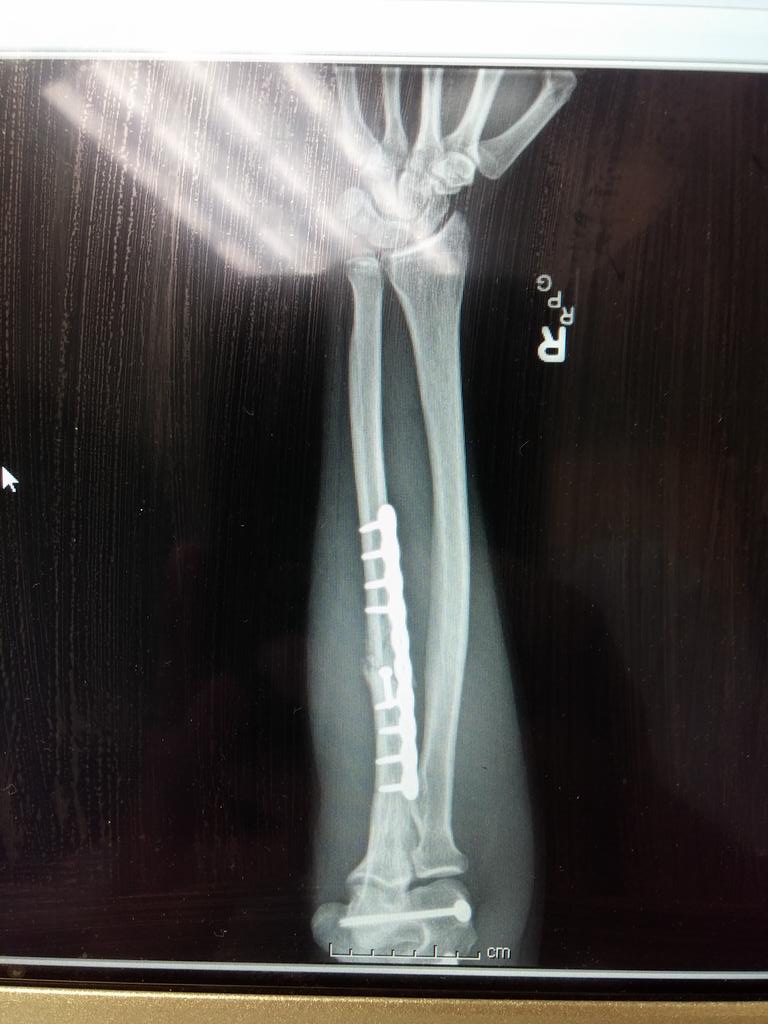 Clintonianfactr's tweet photo. Dude my arm is looking like its fully bionic #ClintProblems #SoooMuchMedal http://t.co/kMB0JdmYk4