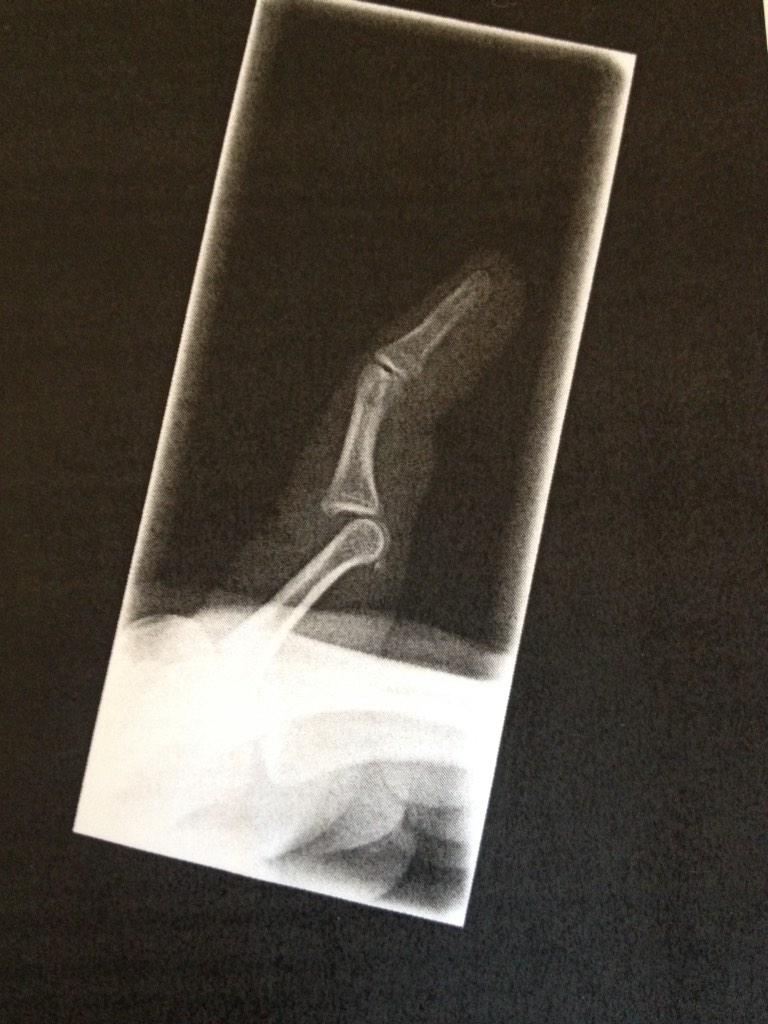 woody_emily's tweet image. Luckily my finger wasn't like this for too long!! #X-Ray #dislocated