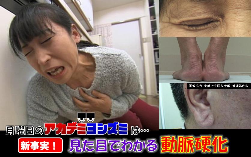 羽鳥慎一モーニングショー Pa Twitter 来週3 9の アカデミヨシズミ は 脳梗塞や心筋梗塞の引き金となる 動脈硬化 に迫ります 最近の研究でまぶたや耳たぶ かかとに動脈硬化の 目に見える異変 が現れることが分かってきました 一体どういうことなのか 石原良純 羽鳥慎一モーニングショー Pa Twitter 来週3 9の アカデミヨシズミ は 脳梗塞や心筋梗塞の引き金となる 動脈硬化 に迫ります 最近の研究でまぶたや耳たぶ かかとに動脈硬化の 目に見える異変 が現れることが分かってきました 一体どういうことなのか 石原良純