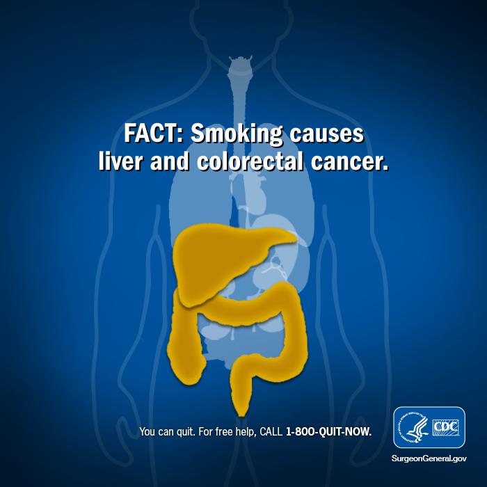 can tobacco cause colon cancer Support those affected by colon cancer by participating in #DressInBlueDay.  Quit smoking & reduce your risk!