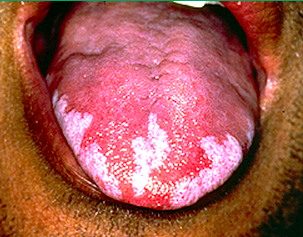 Pearls4IMBoards's tweet photo. Oral hairy leukoplakia

EBV

White corrugated painless plaques affects lateral portions of the tongue among pts w HIV http://t.co/CLEly2FfqB