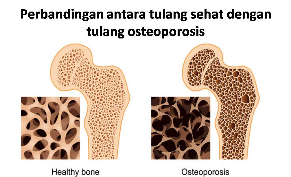 2. Tulang sehat: Memiliki struktur,rongga-rongga yg padat & kuat ...