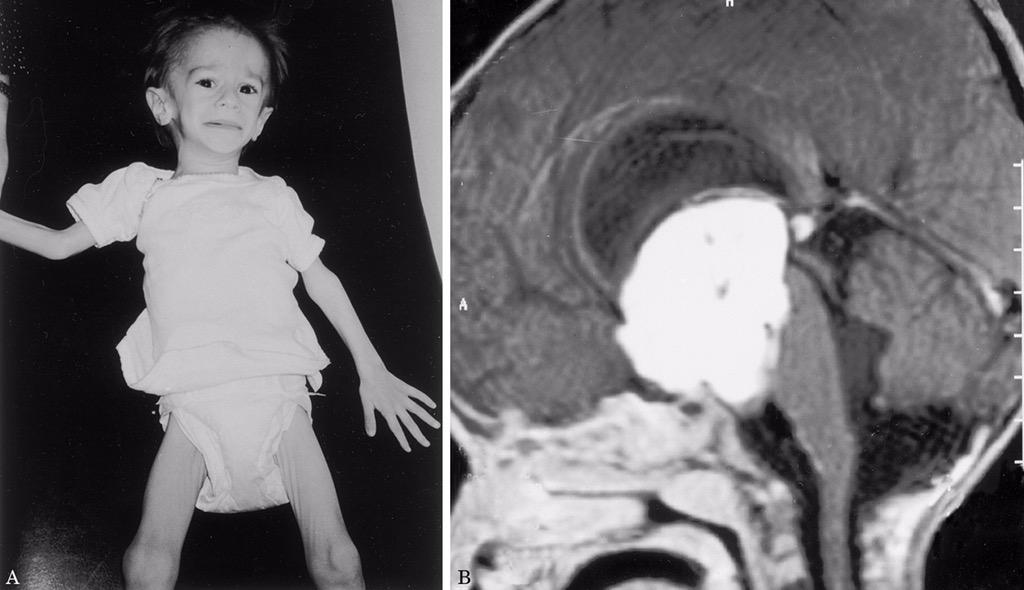 Diencephalon syndrome: emaciated euphoric children w failure to thrive and good appetite. Seen in hypothalamic tumors