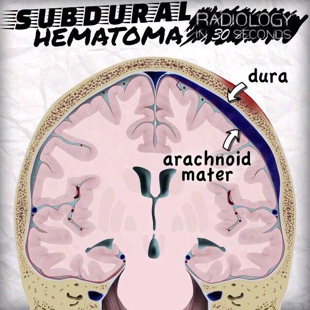 Subdural Hematoma - Radiology in 30 Seconds by <a href="/DrAndrewDixon/">Andrew Dixon</a>. Watch here: goo.gl/KJ64u3 #radiology