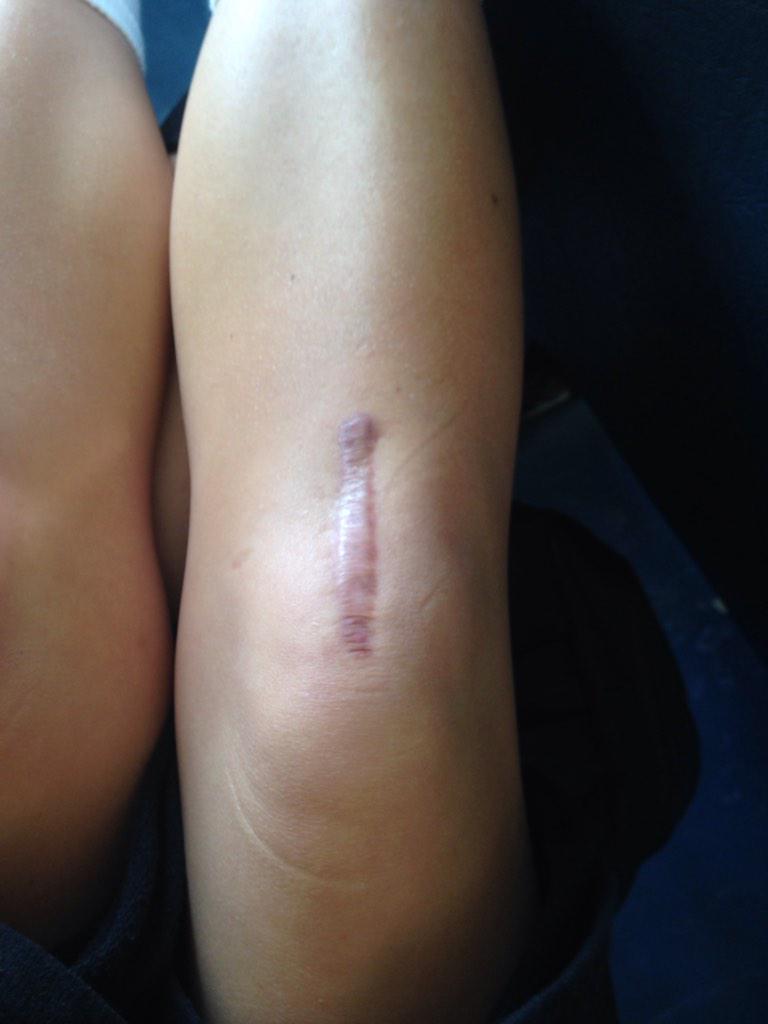 ACL_struggles2's tweet image. Selfknee 😁