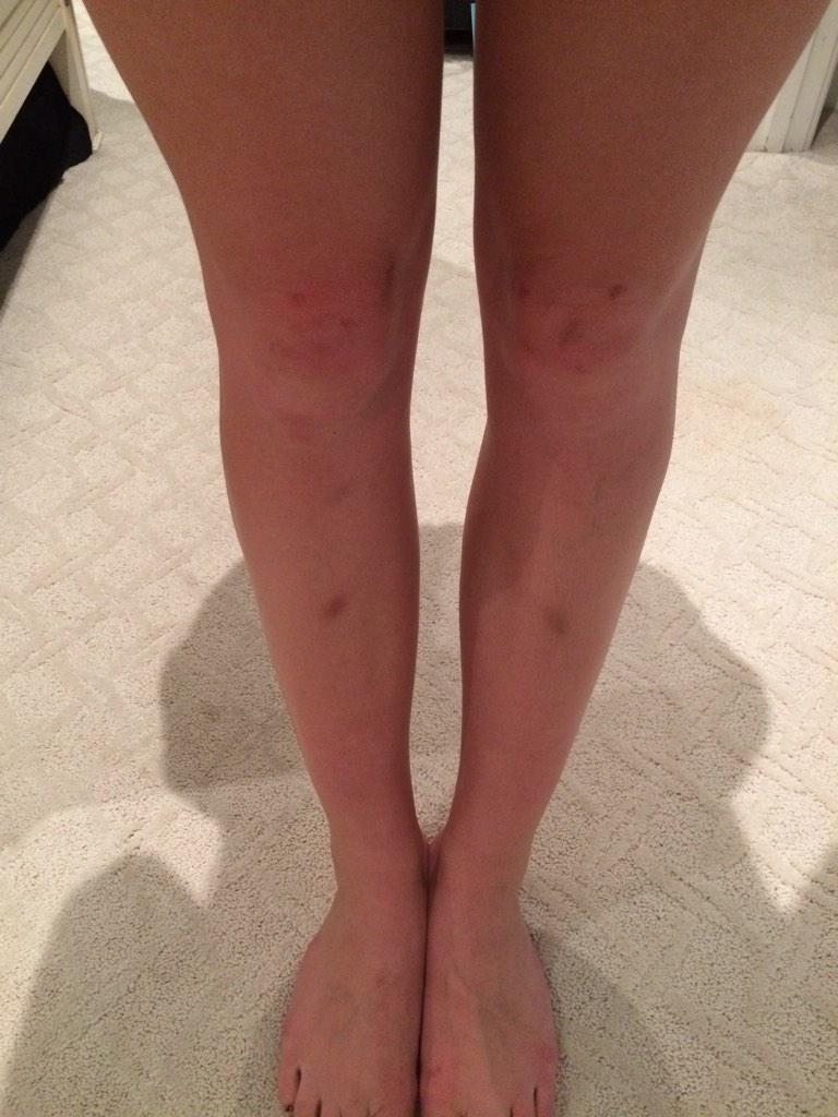 s/o to volleyball for destroying my skin👌👌