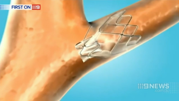 9NewsMelb's tweet photo. Revolutionary non-surgical emphysema treatment announced. @emilyrice28 http://t.co/T2wr3ZvtKS #9News http://t.co/6lL53oyWLf