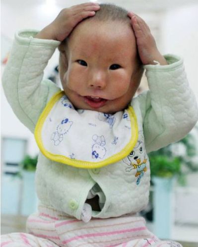 SeriousStrange's tweet photo. A 14-month old in China suffered an unknown facial deformity that made the child look like it had a mask on its face. http://t.co/Dozwtnf2jE