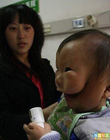 SeriousStrange's tweet photo. A 14-month old in China suffered an unknown facial deformity that made the child look like it had a mask on its face. http://t.co/Dozwtnf2jE