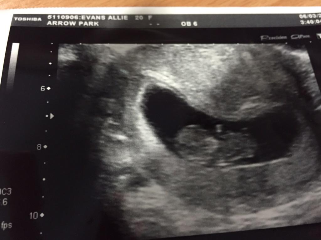AllieEvans18's tweet photo. #baby #finally #future #scanpic #mummytobe #daddytobe #loveyoualready #babybean 💕☺️👣👶🍼 @dannyevo14 http://t.co/Q1ZAkfUZfz