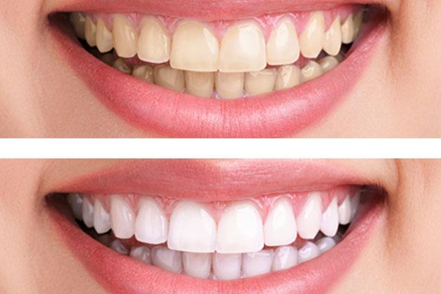 DouglasDentist's tweet photo. Amazing #MarchMadness Offer.Teeth Whitening €150 Call 0214295556 Belvedere Dental Douglas http://t.co/iyCrFQmFzb