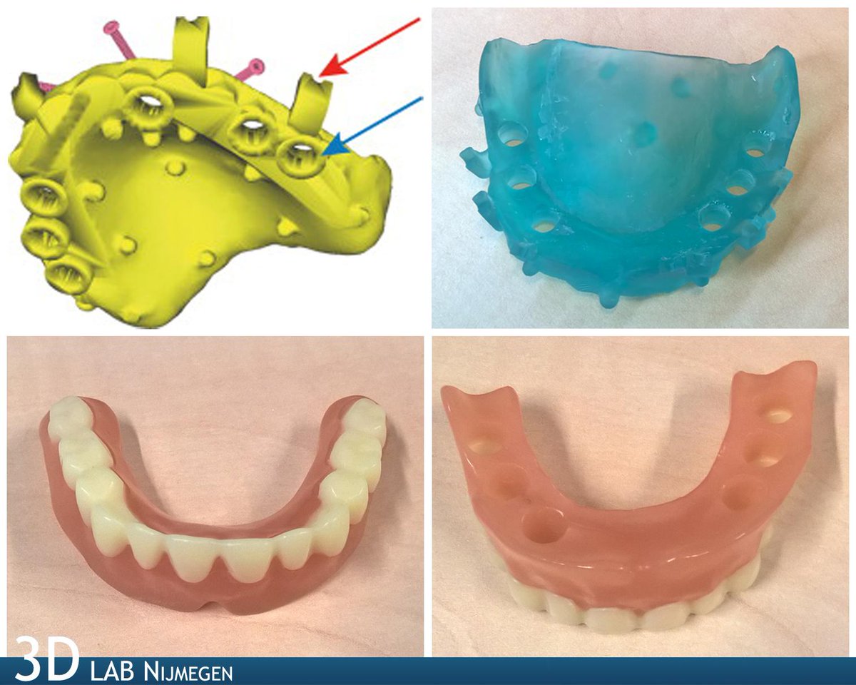 3D Lab Radboudumc (@3dlabradboudumc) on Twitter photo #3Dprint gebitsprothese voor de patiënt na plaatsing van implantaten <a href="/radboudumc/">Radboudumc</a> #patientcare #healthcare #3Dprint gebitsprothese voor de patiënt na plaatsing van implantaten <a href="/radboudumc/">Radboudumc</a> #patientcare #healthcare