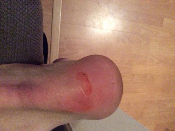 AdamWilton1's tweet photo. @NortonArmy Commitment! Not to mention my cut lip from the knee or whatever! http://t.co/0dy4oOWfBN