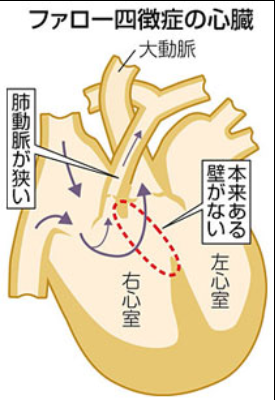 極型ファロー四徴症 - JapaneseClass.jp