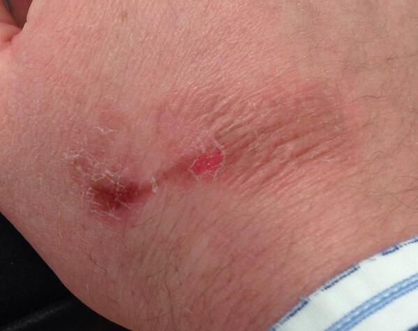 GeezerD205's tweet image. Steam + Skin = Fail. Gives you #oldmanhands #owchie