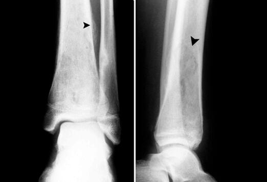Best initial test for Osteomyelitis: X-ray of the bone (elevation of the periosteum seen) #USMLE