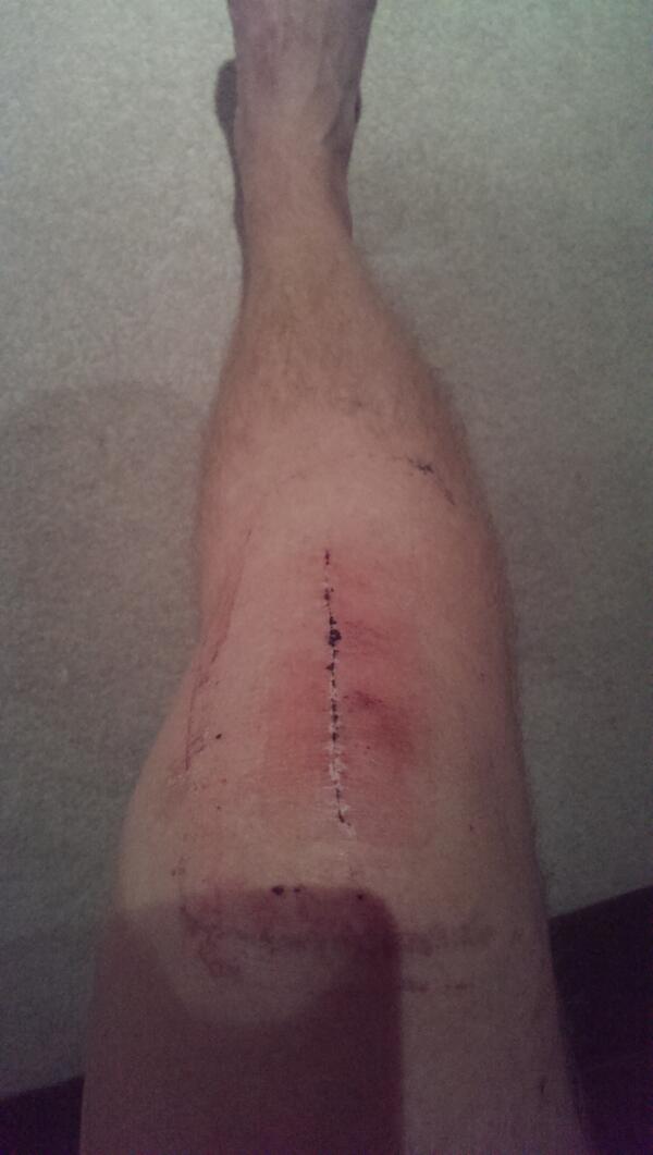 ACLrecoveryBlog's tweet photo. The dressings are off! #smellly http://t.co/8I3B3B46U1