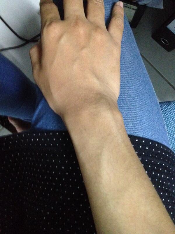 Nieis On Twitter Dok Drslsimonspkk Kalau Tangan Berurat Seperti Ini Tindakan Yg Hrs Dilakukan Apa Ya Saya Ga Pd Mhn Solusinya Tq Http T Co Xwec65dnv3 Twitter