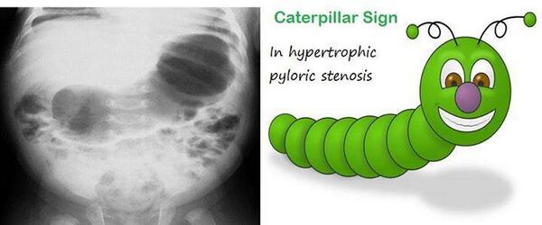 medikole's tweet photo. RT@UsmleAid @prep4USMLE @knowmedge @DrShubhaDeepRoy.
Caterpillar sign in #Pyloric #Stenosis: #Usmle #Radiology #MBBS http://t.co/lTvq9nklfz