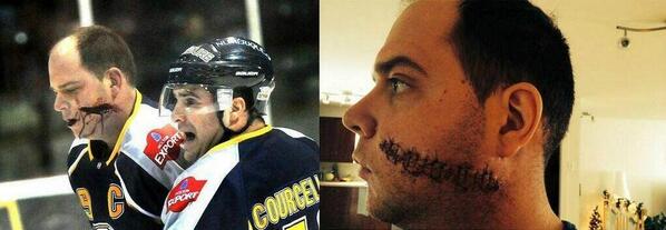 GongshowGear's tweet photo. Update on player who took skate to his face - here is a picture of him zipped up with 54 stitches #GONGSHOW http://t.co/9bEKDWL2Zq